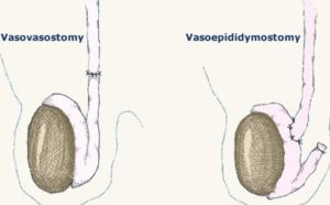 Vasoepididymostomy